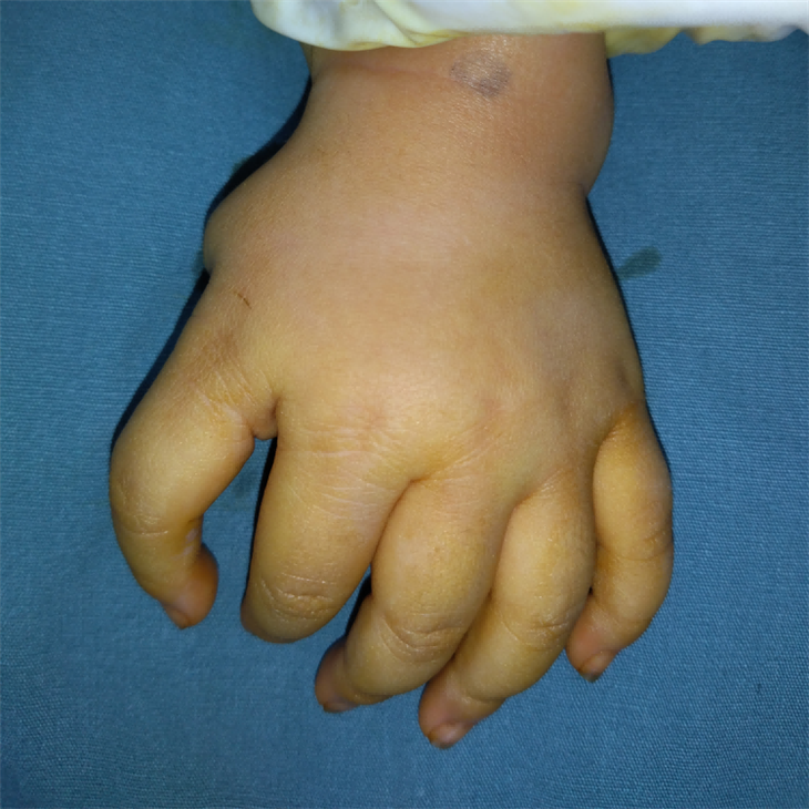 Thumb Triphalangeal Deformity Surgery