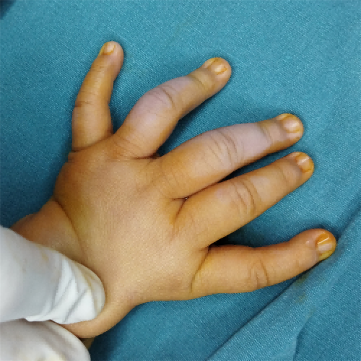 Thumb Triphalangeal Deformity Surgery