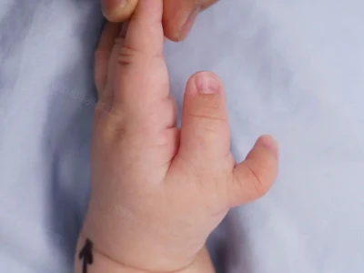Wenn Sie den Daumen Ihres Babys nach der Operation bewerten würden, welche Pu...